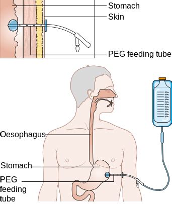 What is a Feeding Tube? - Types & Complications | Study.com