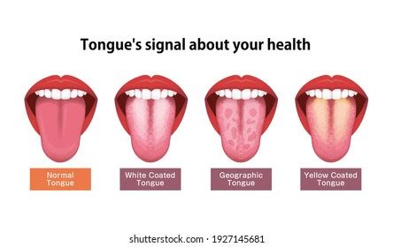 Normal Tongue Coating