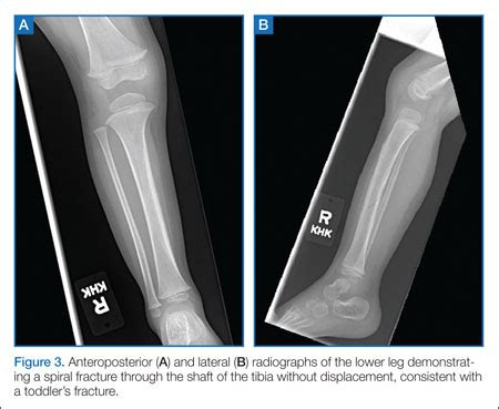 Stress Fracture X Ray Tibia