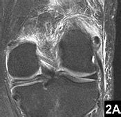 Calcific Tendonitis Of The Fibular Collateral Ligament | My XXX Hot Girl