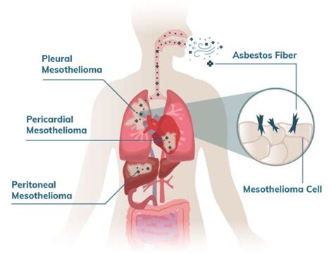 Malignant Mesothelioma Cancer | Stages, Prognosis, Treatment