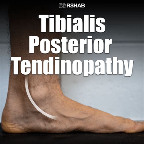 Tibialis Posterior Tendinopathy Exercises