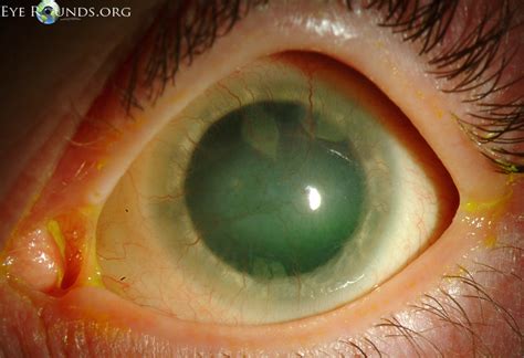 Ocular Manifestations of Stevens-Johnson Syndrome