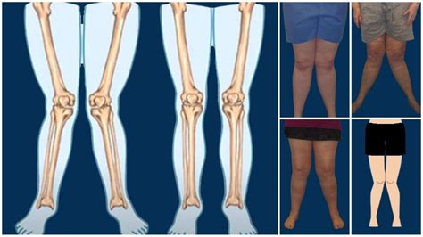 Knock Knee: Causes, Symptoms, Diagnosis and Treatment