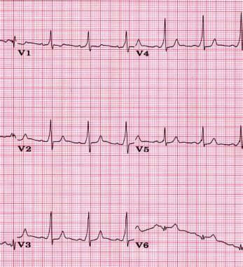 Lown-Ganong-Levine Syndrome Workup: Laboratory Studies, Other Tests, Procedures