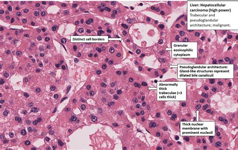 Liver – Hepatocellular Carcinoma – NUS Pathweb :: NUS Pathweb