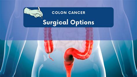 Surgery for colon cancer: Best option for you