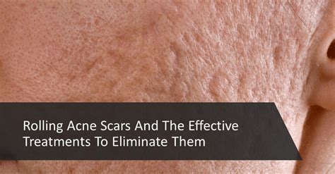 Rolling Acne Scars And The Effective Treatments To Eliminate Them ...