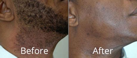 25+ Laser Hair Removal Syracuse - JamesCorvin