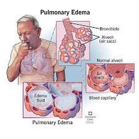 Cause of pulmonary edema - MEDizzy