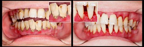 Does Diabetes Affect Teeth And Gums - DiabetesWalls