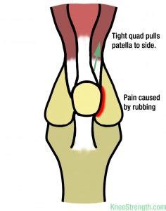 Pin on Patella Maltracking - my sore knees