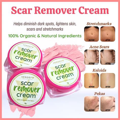 Keloid & Stretch mark Remover Cream Scar Remover Cream MIRACLE CREAM PEKLAT CREAM by VERDEFY ...