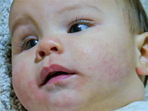 Baby Eczema | Colin had some eczema popping up on his face, … | Flickr