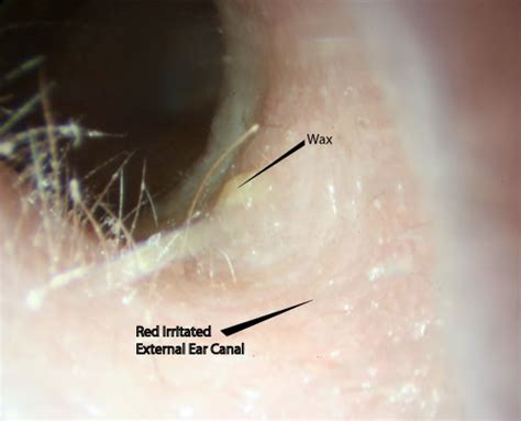 Itchy Ears | McGovern Medical School