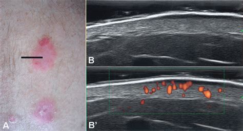 Ultrasound, Skin, and Joints in Psoriatic Arthritis | The Journal of Rheumatology