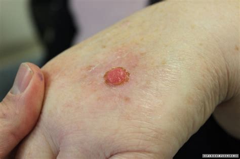 Squamous cell carcinoma | Primary Care Dermatology Society | UK