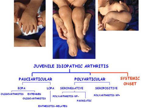 Public Health: Issues, Situation , and Challenges: What Is Juvenile Rheumatoid Arthritis?