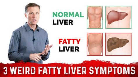 What is fatty liver and how to correct it - Telugu health news