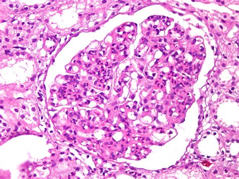 Pathology Outlines - Acute postinfectious glomerulonephritis