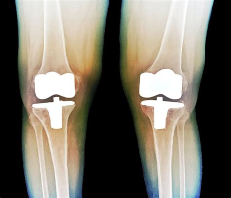 Bilateral Total Knee Replacement Photograph by Zephyr/science Photo Library | Fine Art America