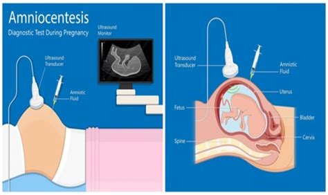 What Is Amniocentesis? | informacionpublica.svet.gob.gt