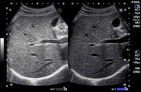 ultrasound physics artifacts Flashcards | Quizlet