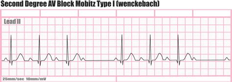 Heart block causes, symptoms, types, diagnosis and heart block treatment