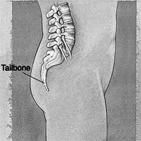 Have YOU Got These Pilonidal Cyst Symptoms?