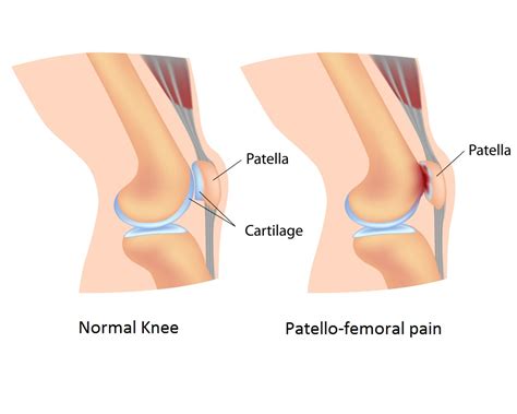 Patellofemoral Pain Syndrome - kneesafe.com