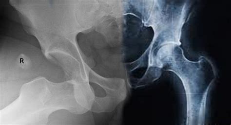 Anterior Vs Posterior Hip Dislocation