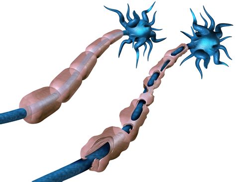 Different Kinds of Spasticity in Multiple Sclerosis » Scary Symptoms