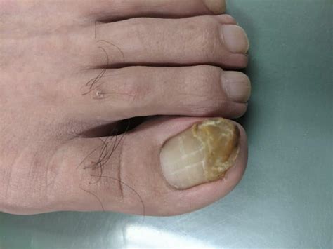 Toenail Fungus Treatment Laser - Beaver Valley Foot Clinic