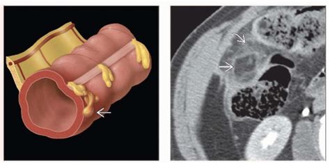 Epiploic Appendagitis | Radiology Key