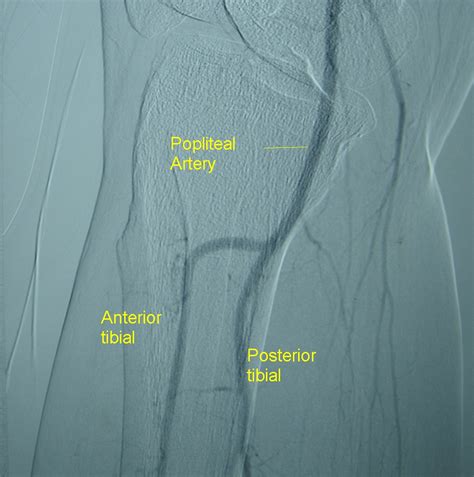 Popliteal artery angiogram – All About Cardiovascular System and Disorders