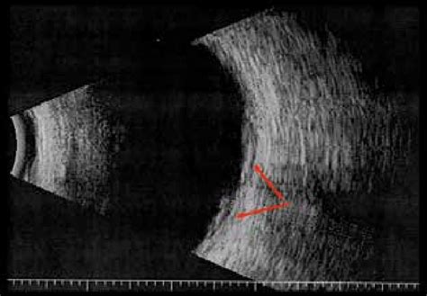 Echographic signs of posterior scleritis: " T-sign " and posterior ...