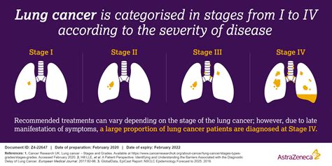 At the forefront of lung cancer treatment