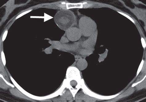 Mediastinal Masses | Radiology Key