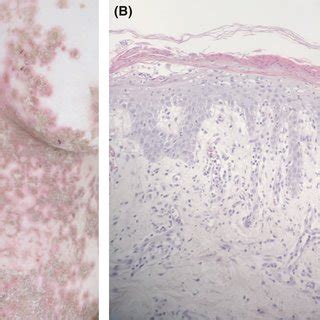 (A) Necrolytic migratory erythema with typical scaling and erythema.... | Download Scientific ...