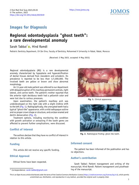 (PDF) Regional odontodysplasia "ghost teeth": a rare developmental anomaly