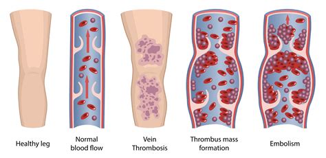 Deep Vein Thrombosis & Blood Clots Treatments In Phoenix AZ