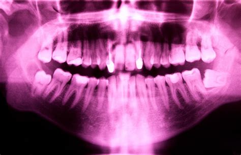 The Causes Of Root Resorption And Its Endodontic Remedies | Dental Country™