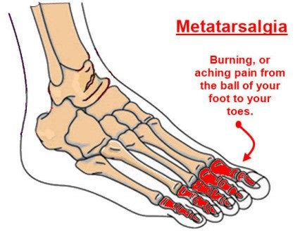 Z-CoiL Metatarsalgia Shoes reduce pressure and pain.