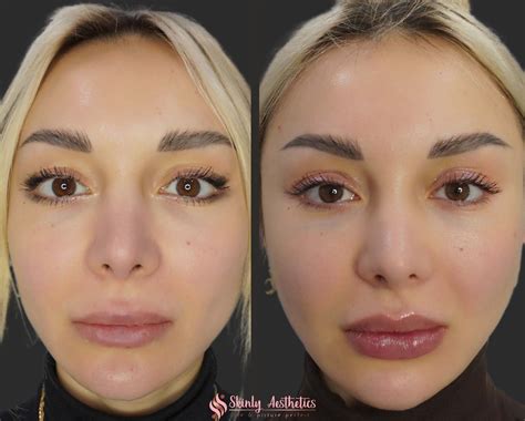 Russian Lip Filler Before After Results Skinly Aesthetics | Sexiz Pix