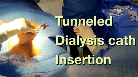 Tunneled Dialysis Catheter insertion (Perm catheter, 피하터널 투석용 카테터 삽입) - YouTube