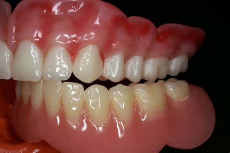 Premium partial and full dentures | Straight from the Dentist's MouthStraight from the Dentist's ...