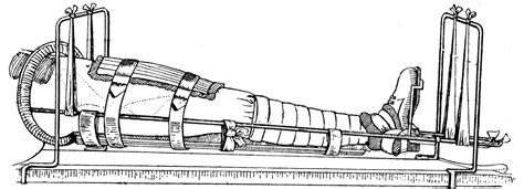 Thomas Splint - Tallis Trenches and Treatment Online Museum.