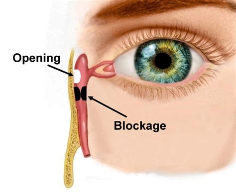 Tear Duct Obstruction - CarlinVision