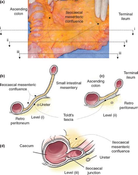 Figure 2 from The mesocolon: a prospective observational study. | Semantic Scholar