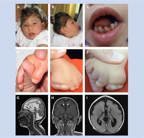 Figure 1 from A syndrome of microcephaly, short stature, polysyndactyly, and dental anomalies ...